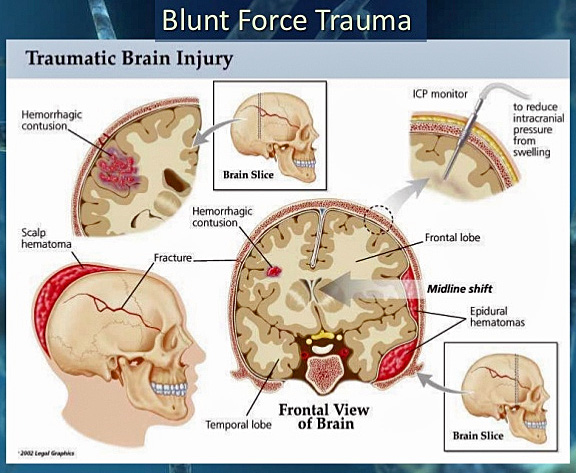 alexis-demetriades-science-illustration-blunt-trauma-to-the-chest